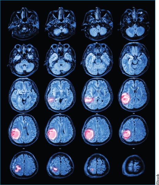OncologyTimes's tweet photo. In a breakthrough study, researchers presented encouraging progress in the treatment of #gliomas at #AACR2023. GD2-targeting CAR-T cells showed promising results, providing hope for potential transformative therapies: https://t.co/aCSe1xUvUd #breakthroughstudy https://t.co/waolJcUonX