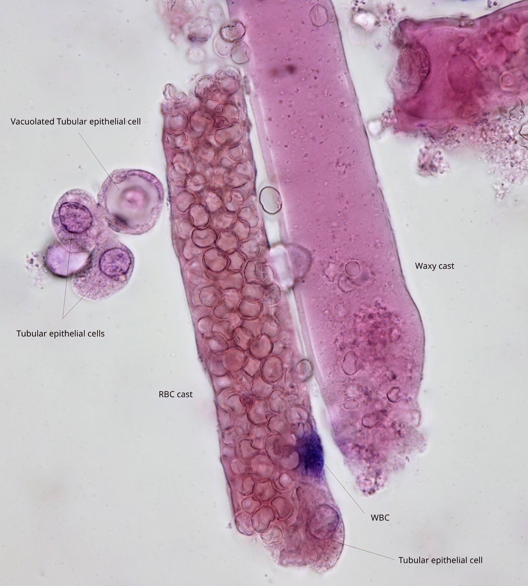 Jay R. Seltzer (@jrseltzer) on Twitter photo RBC cast, waxy cast, and tubular epithelial cells - brightfield, with Prescott-Brodie stain - thanks to <a href="/rmohty/">πππ₯π©π‘ ππ¨π‘ππ² ππ πππ</a> who has resurrected this stain which was originally described in 1964! - Very useful for differentiating WBC's from tubular epithelial cells. Note the dark blue RBC cast, waxy cast, and tubular epithelial cells - brightfield, with Prescott-Brodie stain - thanks to <a href="/rmohty/">πππ₯π©π‘ ππ¨π‘ππ² ππ πππ</a> who has resurrected this stain which was originally described in 1964! - Very useful for differentiating WBC's from tubular epithelial cells. Note the dark blue