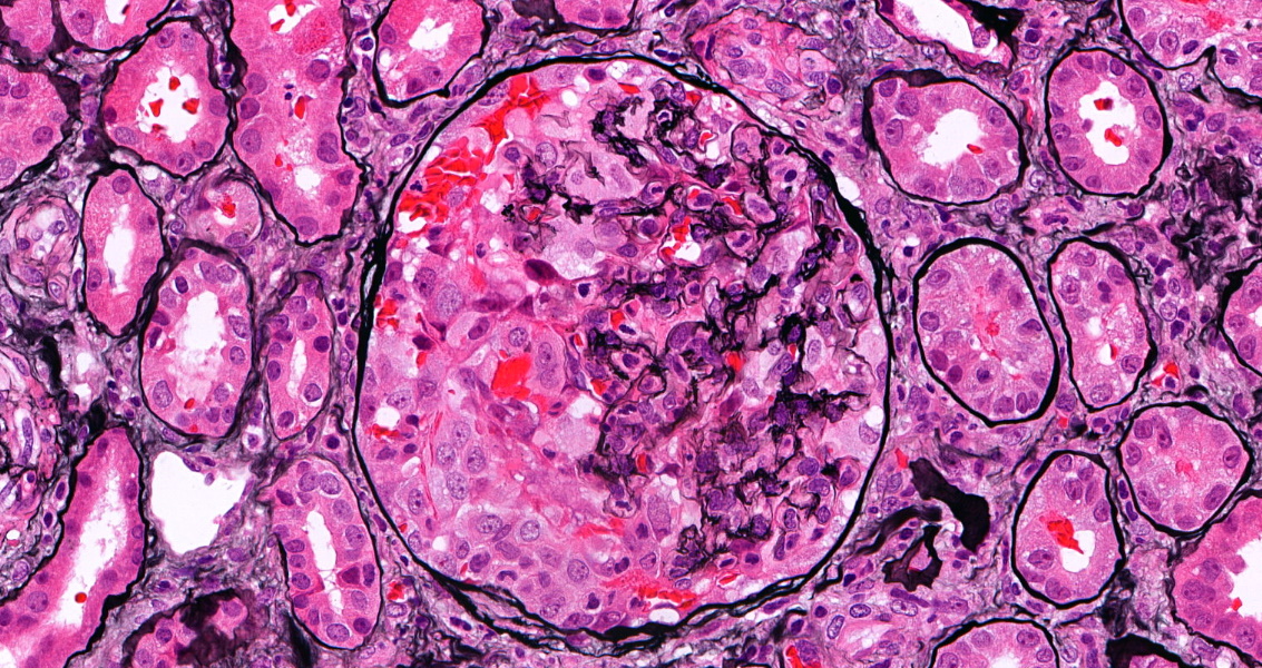 roboonya's tweet photo. Recurrent crescentic IgA nephropathy in 51 yo man. Graft was lost 3 mo after transplant. Although recurrent IgAN is common, rapid graft loss is quite rare. #renalpath #transplantpath https://t.co/dYJZ8F5lfG