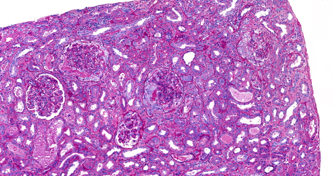 roboonya's tweet photo. Recurrent crescentic IgA nephropathy in 51 yo man. Graft was lost 3 mo after transplant. Although recurrent IgAN is common, rapid graft loss is quite rare. #renalpath #transplantpath https://t.co/dYJZ8F5lfG