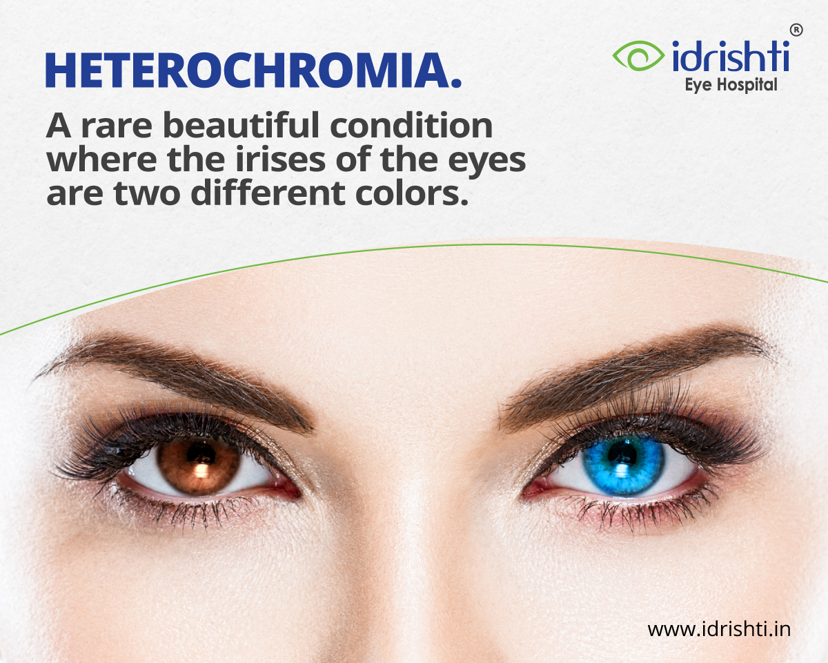 idrishtieyecare's tweet photo. Did you know that Heterochromia is to have eyes of different colours? It can also be a variation within one eye. It's a relatively rare condition, affecting only about 1% of the population. It's also a condition that gives people a unique and striking appearance.
#idrishtieyecare https://t.co/9Gd47muKWN