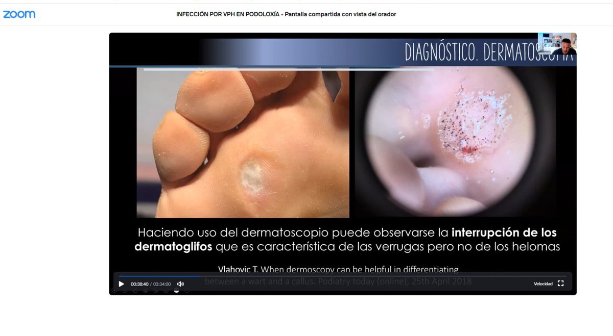 ColexioPodologo's tweet photo. ‼️Actualizamos conocimientos este fin de semana sobre las infecciones provocadas por el Virus del Papiloma Humano en los pies. El curso online fue impartido por el podólogo Javier Alcalá #VerrugasPlantares #papilomas https://t.co/zkb4JyIPhW