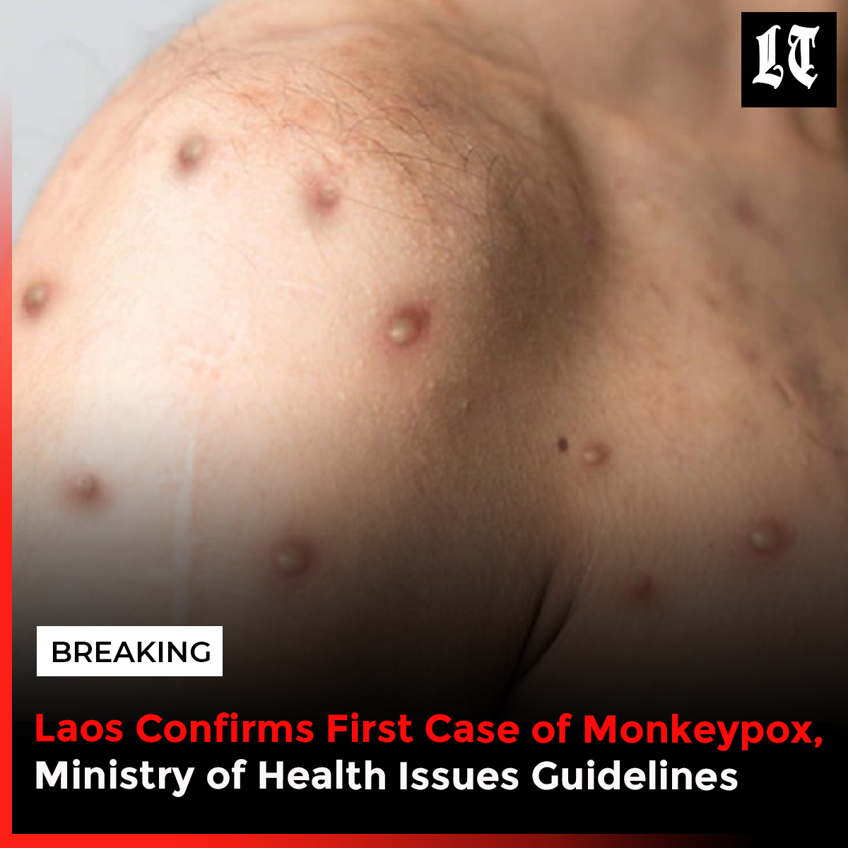 According to the notice, the first case of #monkeypox infection was recorded on 8 September; however, the ministry has not provided any further information about the patient.

Read more: buff.ly/3RrlrLE