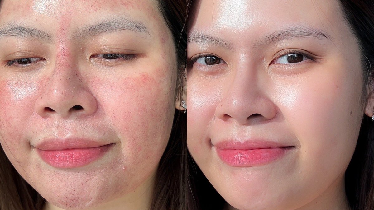 มีคนถามว่าหลังทำหัตถการอย่าง Picosecond Laser ต้องใช้สกินแคร์อะไร ยกให้ลาโรช #Cicaplast Baume B5+ ยืนหนึ่งเลยค่ะ เห็นทุกคนรีวิวว่าหลังไปทำ Pico ต้องใช้ตัวนี้เลย พอได้มาอ่านส่วนผสมคือ เค้ามีส่วนผสมช่วยทำให้ Microbiome บนผิวสมดุล เวลาผิวเราทำ Pico มา