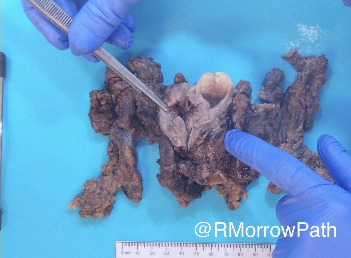 #Grosspath time! 
🕺name the specimen 
🕺name the tumour site
🕺name the most common tumour here
🕺what AJCC chapter will you stage by?
🍿stays tuned for part 2: the cut surface….. 
#pathology #entpath #pathresident