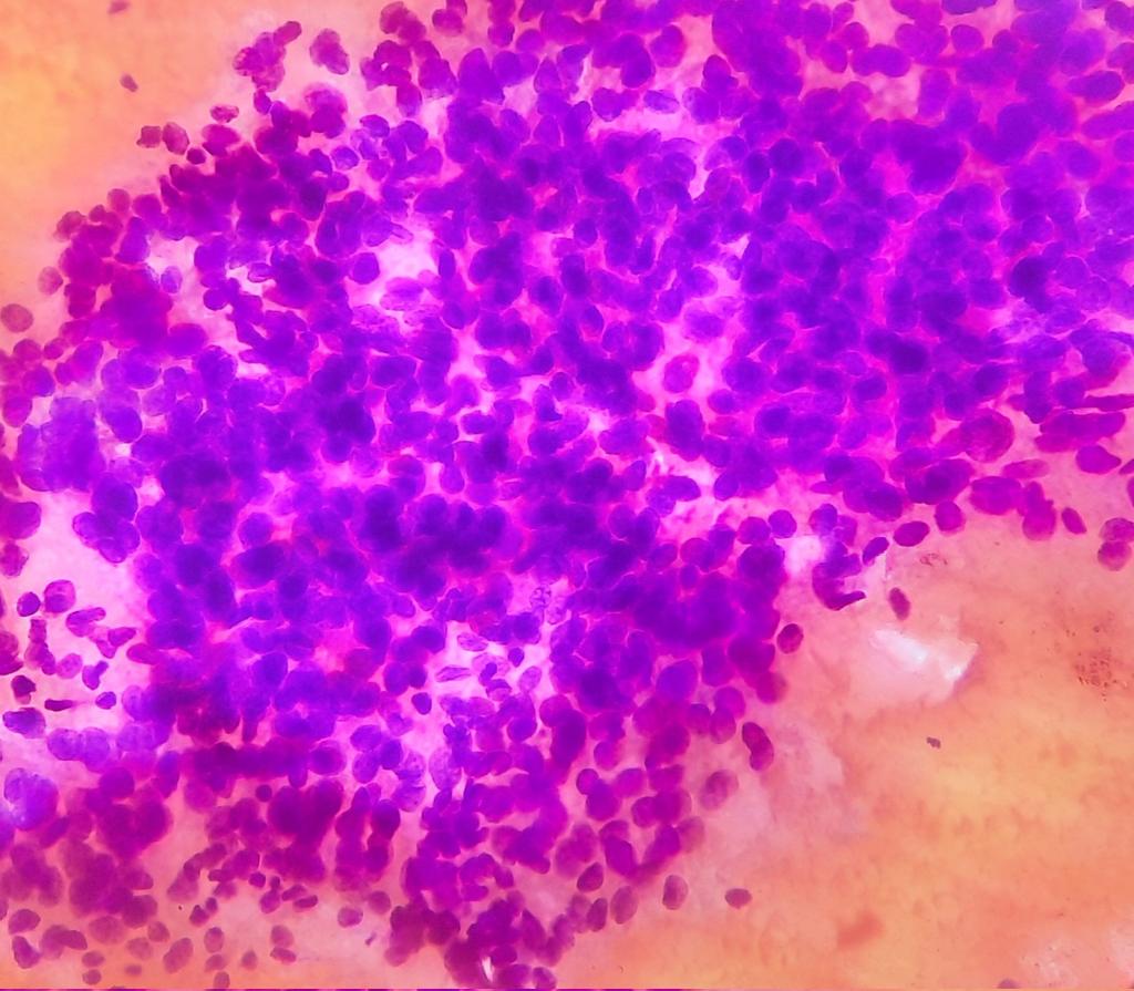amnabruno's tweet image. 💊45 years old, female
💉 FNAC Thyroid
☢️ TIRADS V Lesion on Ultrasound. 
#TwitterPath #MedTwitter #SurgicalPathology #Histopathology #Thyroid