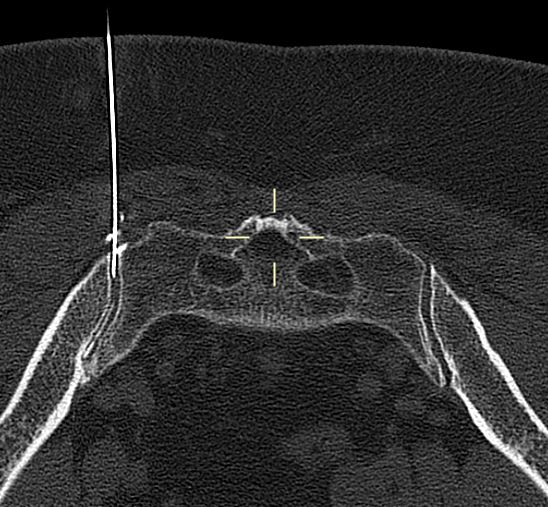 themskarchive's tweet photo. 20/9/2023. We performed a CT-guided right sacroiliac joint therapeutic-diagnostic infiltration with steroids and anesthetics, adding iodine contrast to confirm intraarticular treatment. Prone position.   #MSK #rehabilitation #traumatology #pain #CT #intervention https://t.co/94D41uEkWV