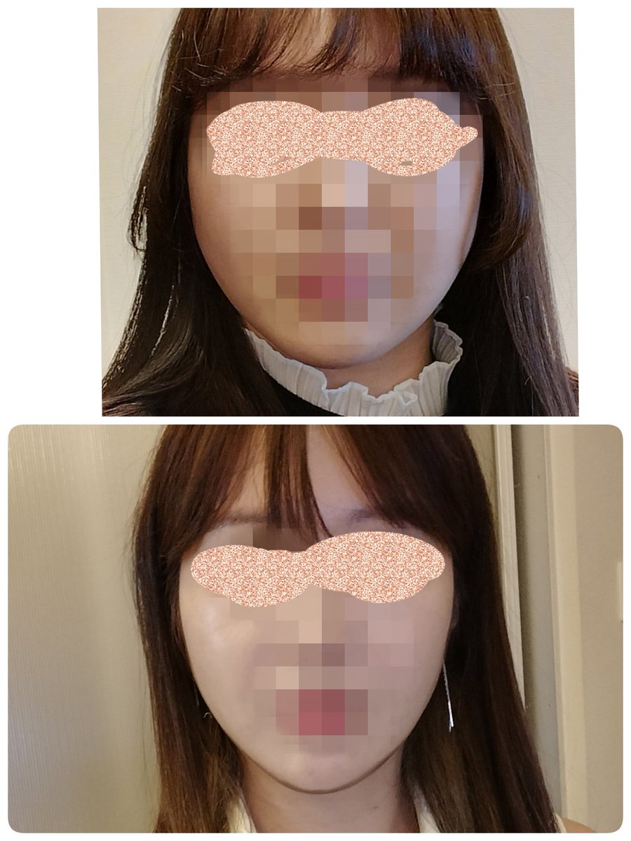 moumuripo2222's tweet photo. 🇰🇷顔の脂肪吸引3回目レポ
(2023/1施術)

室長さんにお勧めされてノリでやった顔の脂肪吸引が、人生TOP5に入るほど良かった…
生まれて初めて(たまに)「小顔」と言われるようになった🙏
取る量よりもデザインが大事だと改めて実感！

スタート整形外科@startplasty レビュー割で執刀してもらいました～ https://t.co/RWaGyKZ6Wl