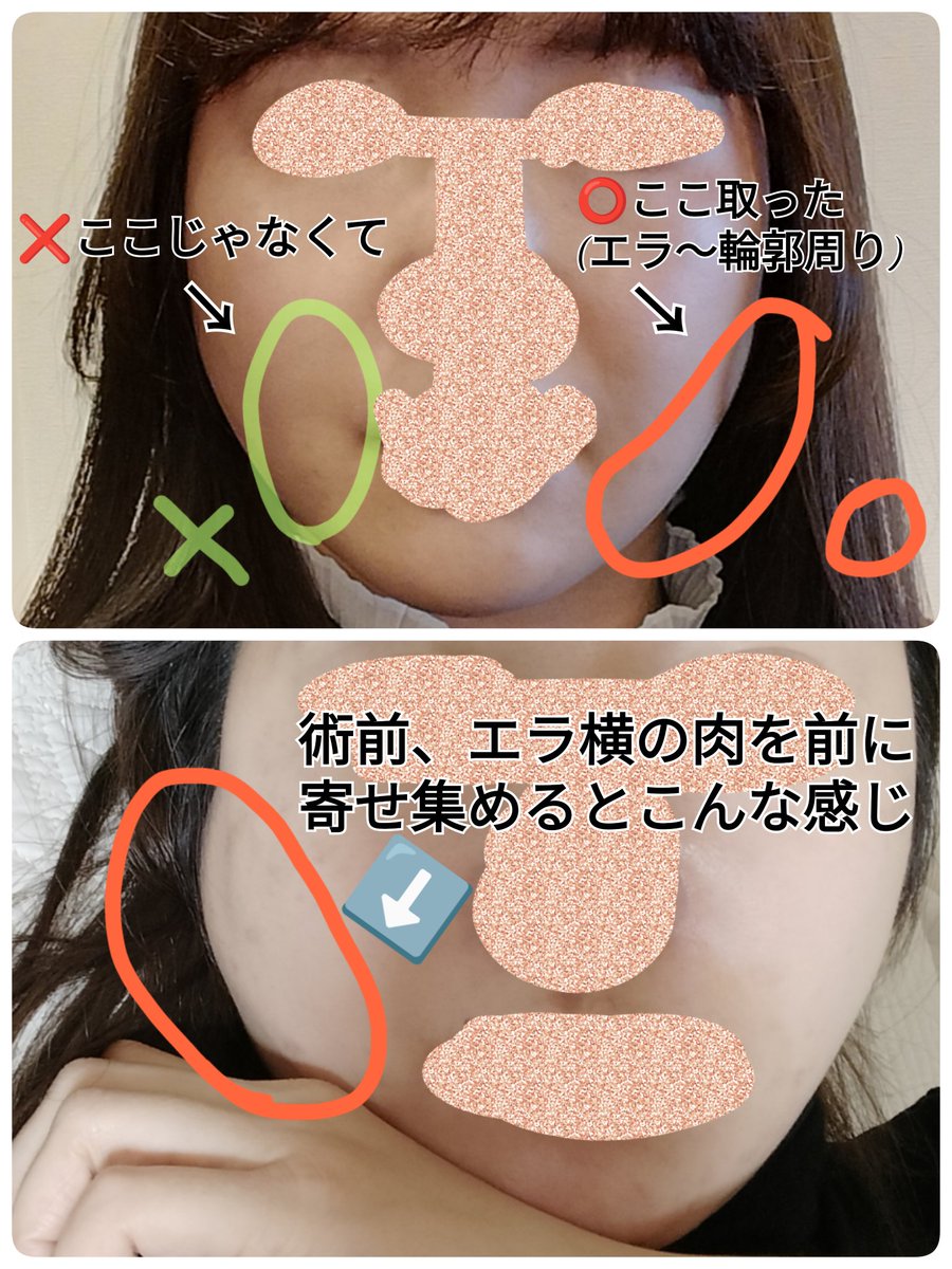 moumuripo2222's tweet photo. 🇰🇷顔の脂肪吸引3回目レポ
(2023/1施術)

室長さんにお勧めされてノリでやった顔の脂肪吸引が、人生TOP5に入るほど良かった…
生まれて初めて(たまに)「小顔」と言われるようになった🙏
取る量よりもデザインが大事だと改めて実感！

スタート整形外科@startplasty レビュー割で執刀してもらいました～ https://t.co/RWaGyKZ6Wl