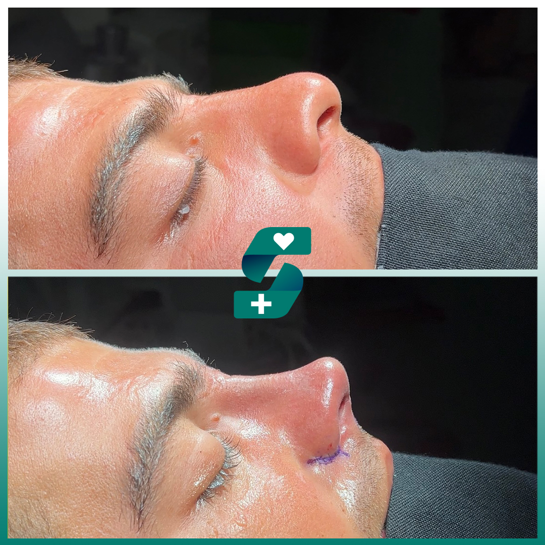 soracamed's tweet photo. Be As You Like 💫

Free Consultation ✅
Free Hotel Stay (2 Persons )🛎
Free Transfer Services (Airport - Hotel - Hospital) 🧳
First Medication is included
https://t.co/387MLgVJ0e 🌐

#rinoplasti #nosejobturkey #rhinoplasty #nosejob #antalyarinoplasti #rhinoplastylondon https://t.co/HMKR0ulCba
