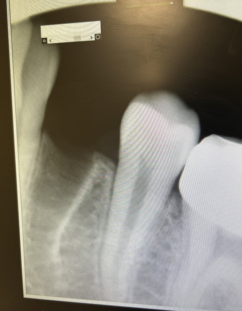 Pt was referred to <a href="/Aseel_Dental/">Aseel Mohammed Salem</a> from ortho for extraction of tooth #34 apical third was fractured due to the dilaceration. 
 
I used Explorer to wedge it out and the 
fracture tip was successfully retrieved. الحمدلله