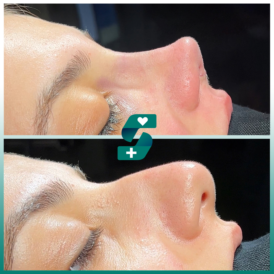 soracamed's tweet photo. Be As You Like 💫

Free Consultation ✅
https://t.co/387MLgVJ0e 🌐

#rinoplasti #nosejobturkey #rinoplastica #nosejob #antalyarinoplasti #rhinoplastylondon #rhinoplastyfrance #turkeyrhinoplasty #istanbulrhinoplasty #revisionrhinoplasty #alanyarinoplasti #nosesurgery https://t.co/0PBHCHAkrp