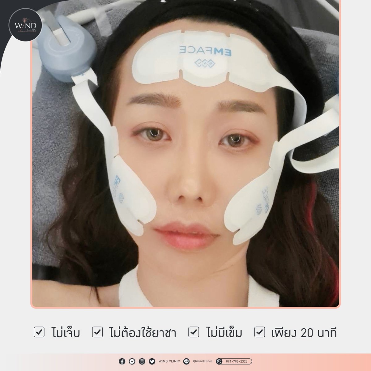 windclinic's tweet photo. ยกไว ไม่เจ็บ นวัตกรรมใหม่ของการยกกระชับ
𝗘𝗠𝗙𝗔𝗖𝗘  กระตุ้นลึกถึงชั้นกล้ามเนื้อ
✔  ลดริ้วรอย
✔ แก้มยก
✔  ลดร่องแก้ม
✔ ใบหน้าเรียว กรอบหน้าชัด
✔ กระตุ้นการสร้างคอลลาเจนและอิลาสติน

✅ ใช้เวลาเพียง 20 นาที

#หมอบาส_นายแพทย์เฉลิมชัย_ศรีอัครพงศ์
#ปรับรูปหน้า  #ปีใหม่ 
#emface https://t.co/cPbYcvfAK3