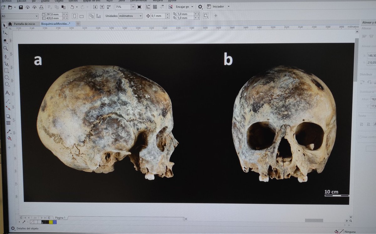 Quick tapho-quiz #archaeoTwitter! Cremation or manganese? 💀🤔😁🧐 #Quiz #Taphonomy #Anthropology Context: young adolescent, Early #BronzeAge, collective burial in cave, northeastern iberian península. #RocOrenetes <a href="/ArrelsP/">ARRELS Prehistòriques</a> #Pyrenees ⛰️ <a href="/taphonomy_iphes/">Area de Tafonomia y Zooarqueologia</a>