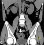 JPGNonline's tweet image. A teenager presents with colicky abdominal pain suspected to be from an intussusception.

What is the most likely mechanism for a Meckel's diverticulum to cause an intussusception?

@‌huseyinozbey13

Answer and learn more 👉 bit.ly/3htf9YP?utm_so…

#imageofthemonth #quickpoll