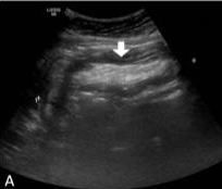 JPGNonline's tweet image. A teenager presents with colicky abdominal pain suspected to be from an intussusception.

What is the most likely mechanism for a Meckel's diverticulum to cause an intussusception?

@‌huseyinozbey13

Answer and learn more 👉 bit.ly/3htf9YP?utm_so…

#imageofthemonth #quickpoll