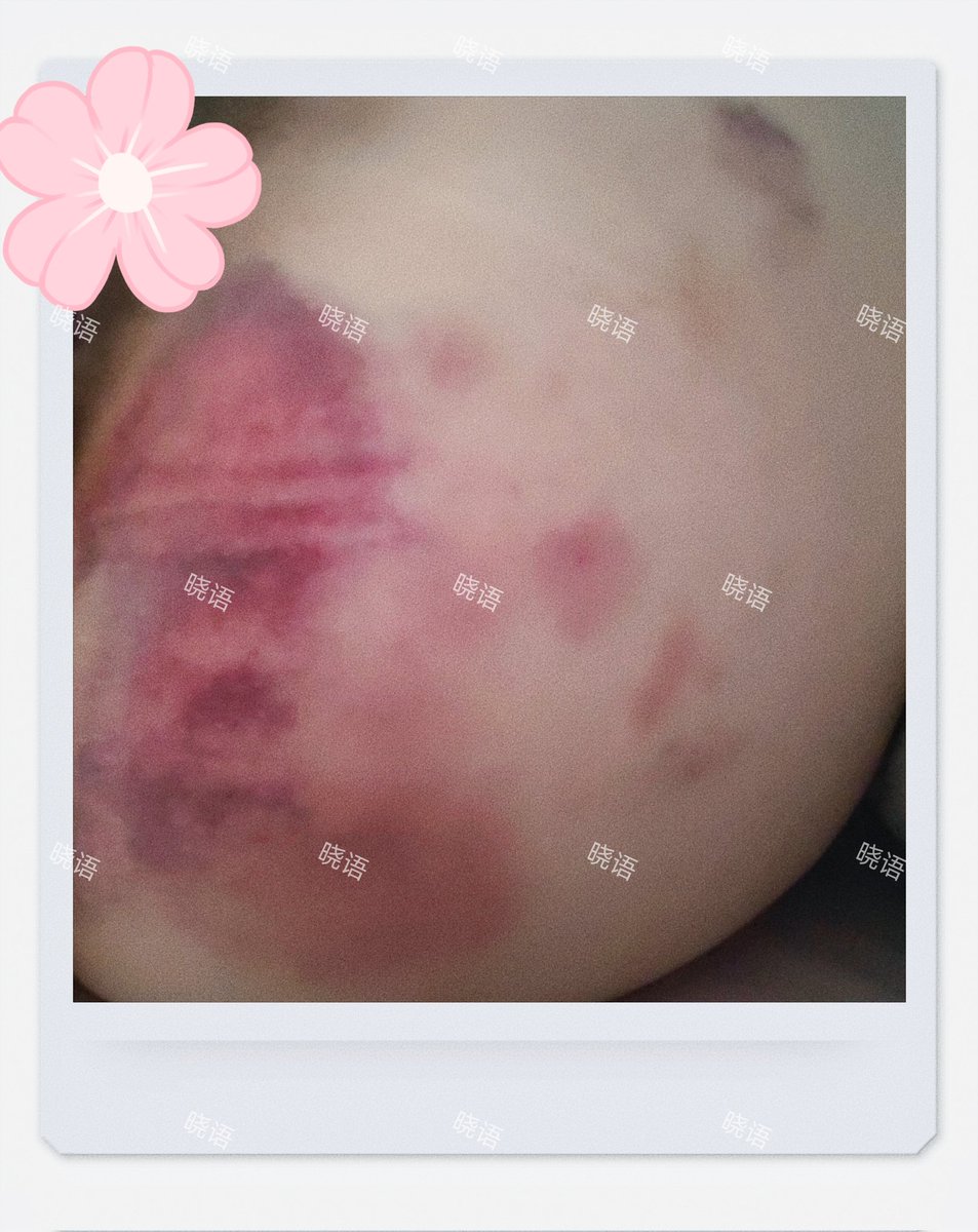 xiaoyuazj's tweet photo. 怎么说呢
这玩意他
三天好了
就他妈离谱 https://t.co/Z6CLIhIMvf