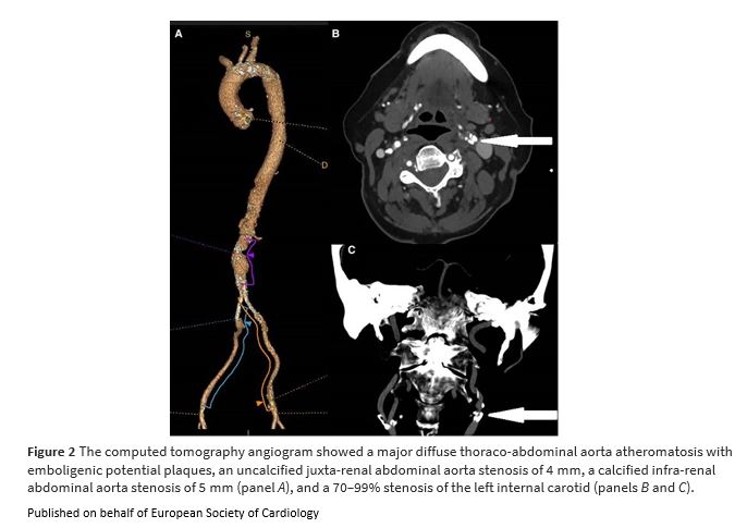 European Society of Cardiology Journals (@esc_journals) on Twitter photo Combined approach of carotid endarteriectomy + transcarotid TAVI as a minimally invasive one-step treatment of aortic stenosis. See how it was done. bit.ly/45WYHYA
#EHJCaseReports <a href="/KardiologieHH/">Erik Rafflenbeul</a> <a href="/aayshacader/">Aaysha Cader</a> <a href="/ANazmiCalik/">A.Nazmi Calik</a> <a href="/TJ_Yeo/">Tee Joo YEO</a> <a href="/FarhanaAra/">Farhana</a> <a href="/Phiso_de/">Philipp Sommer</a> <a href="/EHJCREiC/">EHJCaseReports Editor-in-Chief</a> #CardioX Combined approach of carotid endarteriectomy + transcarotid TAVI as a minimally invasive one-step treatment of aortic stenosis. See how it was done. bit.ly/45WYHYA
#EHJCaseReports <a href="/KardiologieHH/">Erik Rafflenbeul</a> <a href="/aayshacader/">Aaysha Cader</a> <a href="/ANazmiCalik/">A.Nazmi Calik</a> <a href="/TJ_Yeo/">Tee Joo YEO</a> <a href="/FarhanaAra/">Farhana</a> <a href="/Phiso_de/">Philipp Sommer</a> <a href="/EHJCREiC/">EHJCaseReports Editor-in-Chief</a> #CardioX