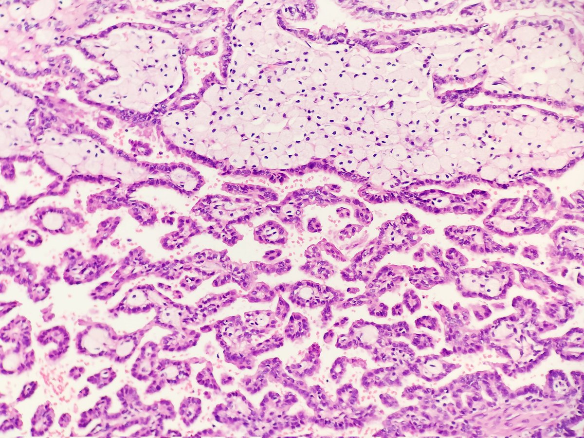 padmapathology1's tweet photo. #PathTwitter
#macropath #MacroMicroCorrelation
#pathclassics
#PapillaryRenalCellCarcinoma https://t.co/7DaSEGQsuV