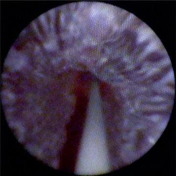 European Urology (@euplatinum) on Twitter photo Feasibility and Outcomes of Temporary Bulbar Urethral Stent Placement After Internal Urethrotomy in the Largest Multicenter Series
buff.ly/3RJhFh9
<a href="/dalmetto/">Ettore Dalmasso</a> <a href="/Alqattan_J/">Yaqoub Alqattan</a> <a href="/paolo_gontero/">Paolo Gontero</a> Feasibility and Outcomes of Temporary Bulbar Urethral Stent Placement After Internal Urethrotomy in the Largest Multicenter Series
buff.ly/3RJhFh9
<a href="/dalmetto/">Ettore Dalmasso</a> <a href="/Alqattan_J/">Yaqoub Alqattan</a> <a href="/paolo_gontero/">Paolo Gontero</a>