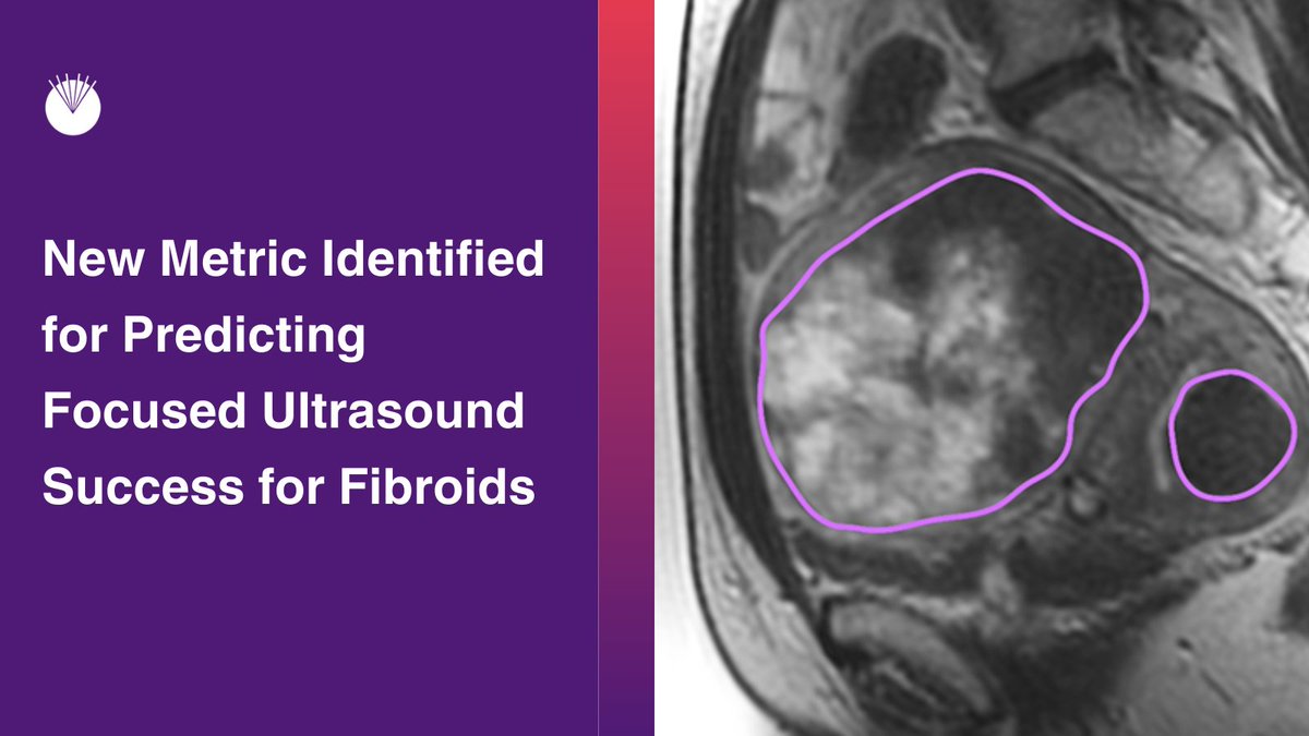 FUSFoundation's tweet image. A team of researchers has identified a new metric for predicting success when using #focusedultrasound to ablate #uterinefibroids. They examined long-term outcomes and identified a novel variable based on total fibroid load as a key durability parameter. 
ow.ly/JRLH50PMXFJ
