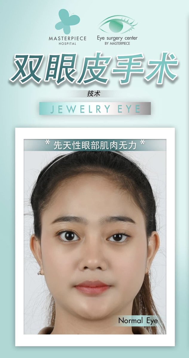 namtanrrn's tweet photo. Jewelry eyes 双眼皮修复

先修复 “眼皮层厚，眼层不一样大，面部看起来很老”

做到一个月 “眼皮是一样，脸看起来甜美，面部看起来更年轻”  热钱: +8170-1396-0780
Line Id :namtarn555preeyanuch
微信:masterpiece_cn
WhatApp: +817013960780
每天开业，时间早上10点 到 晚上8点 https://t.co/MzeAaYeOP8