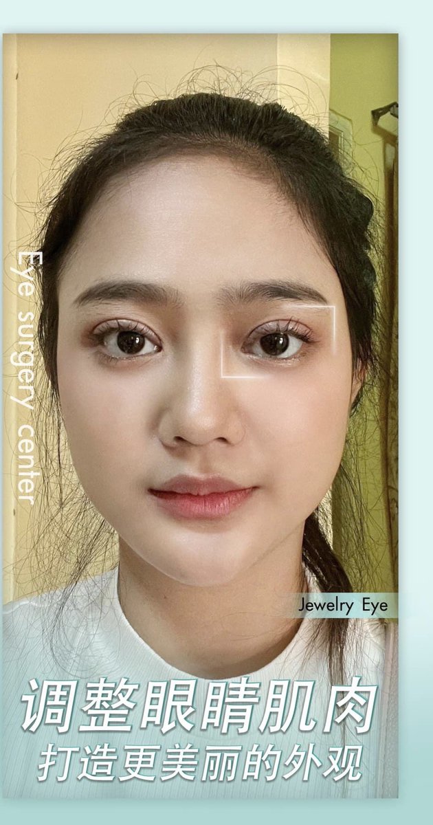 namtanrrn's tweet photo. Jewelry eyes 双眼皮修复

先修复 “眼皮层厚，眼层不一样大，面部看起来很老”

做到一个月 “眼皮是一样，脸看起来甜美，面部看起来更年轻”  热钱: +8170-1396-0780
Line Id :namtarn555preeyanuch
微信:masterpiece_cn
WhatApp: +817013960780
每天开业，时间早上10点 到 晚上8点 https://t.co/MzeAaYeOP8
