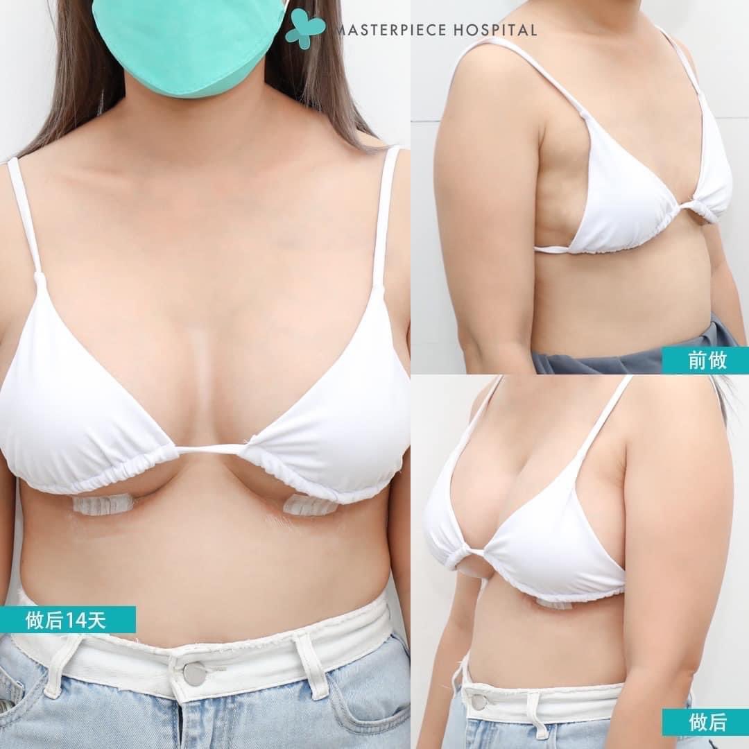 namtanrrn's tweet photo. 一对新的乳房 在masterpiece医院
费询问
-美丽的胸型
-设计一对一
免费咨询专业医生 *
由经验丰富的外科医生 医院等级标准 
和麻醉师在整个手术过程中密切监督
如果你有感兴趣，请询问更多细信息
联系这里
热钱: +8170-1396-0780
Line Id :namtarn555preeyanuch
微信:masterpiece_cn https://t.co/78z5lm5xJ3
