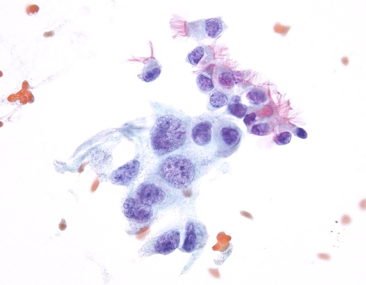 sza_jhcyto's tweet photo. “Black and White” -  Adenocarcinoma contrasting with benign. (Lung, EBUS FNA) https://t.co/EujxvVwA7c