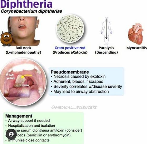 <a href="/BrownJHM/">Journal of Brown Hospital Medicine</a> Diphtheria an acute and highly contagious bacterial disease causing inflammation of the mucous membranes, formation of a false membrane in the throat which hinders breathing and swallowing, and potentially fatal heart and nerve damage by a bacterial toxin in the blood.