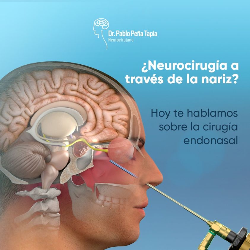 La cirugía endonasal es un enfoque innovador en neurocirugía. 

Se realiza a través de las fosas nasales, sin incisiones externas. Trata tumores cerebrales y más, con menos dolor y recuperación rápida. 

Confía en la experiencia de Dr. Pablo Peña. Contáctanos al  ➡️0995844449.