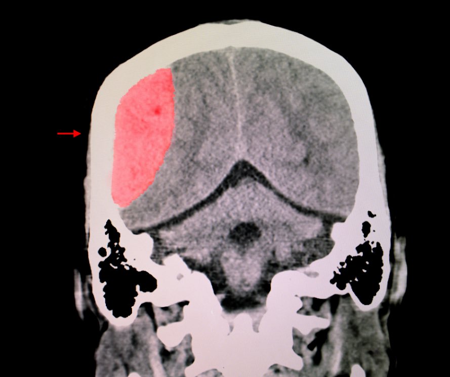 Simkovich Concussion Institute tweet media
