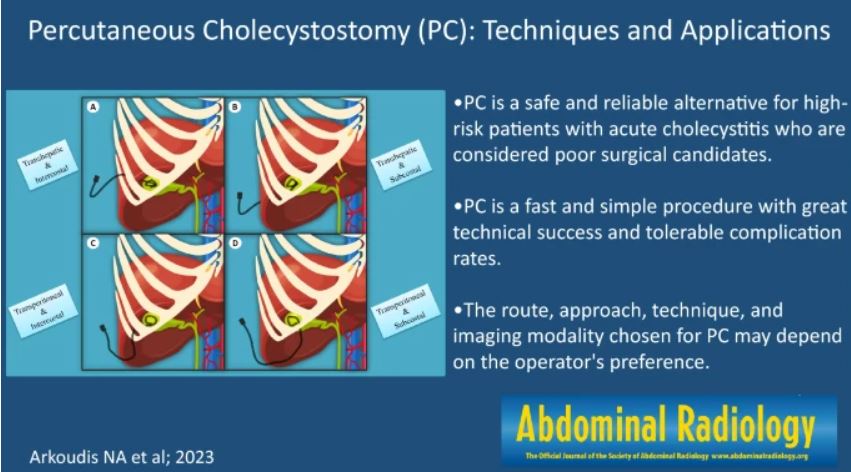 Abdominal_Rad's tweet photo. Graphical abstract published 6/20/2023
#abdradj #radiology

Percutaneous cholecystostomy: techniques and applications.

Nikolaos-Achilleas Arkoudis et al

https://t.co/FMlLI04fee https://t.co/VS33gUSgdk