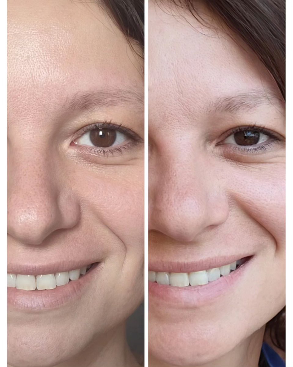 mmeechantillon's tweet image. Après plus d'un mois d'utilisation, voilà les résultats de l'effet #bonnemine d'#eyecarecosmetics 
Ma peau est:
- moins brillante
- mes pores sont plus resserrés
-la peau est visiblement plus nette
Merci @monvanityideal pour cette jolie séléction
 #monvanityideal #bonnemine