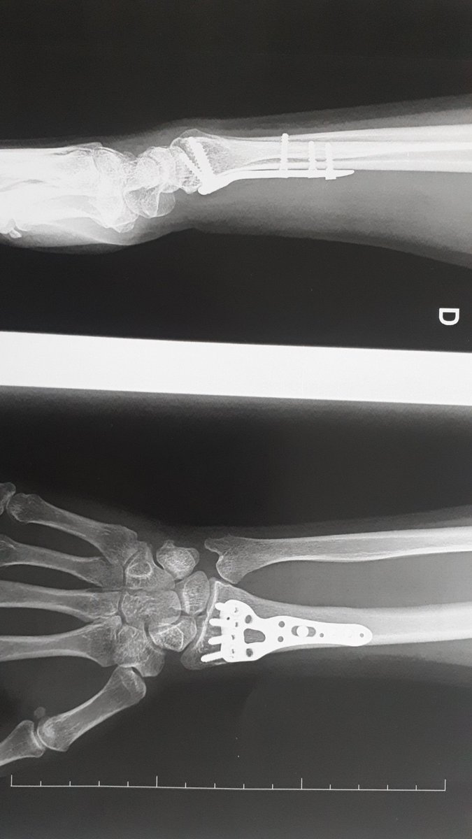 chamolko's tweet image. Ce matin c'était contrôle avec le chirurgien. Tout est parfaitement consolidé. Je repasse au bloc le 12 octobre pour retirer la quincaillerie. Bientôt la fin. 
Avant ça ce sera 2 semaines de vacances bien méritées. Je suis crevée. 
#dubonheursurmonbiclou 😆