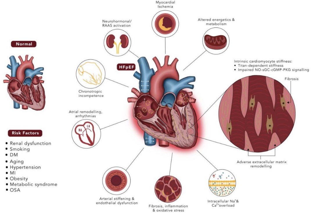 cardioteca's tweet photo. 🆕📌 ¿Por qué son beneficiosos los iSGLT2 en la insuficiencia cardiaca con FEVI preservada?

📁 https://t.co/Ka8Xkgnlng https://t.co/hH93F0YJFC