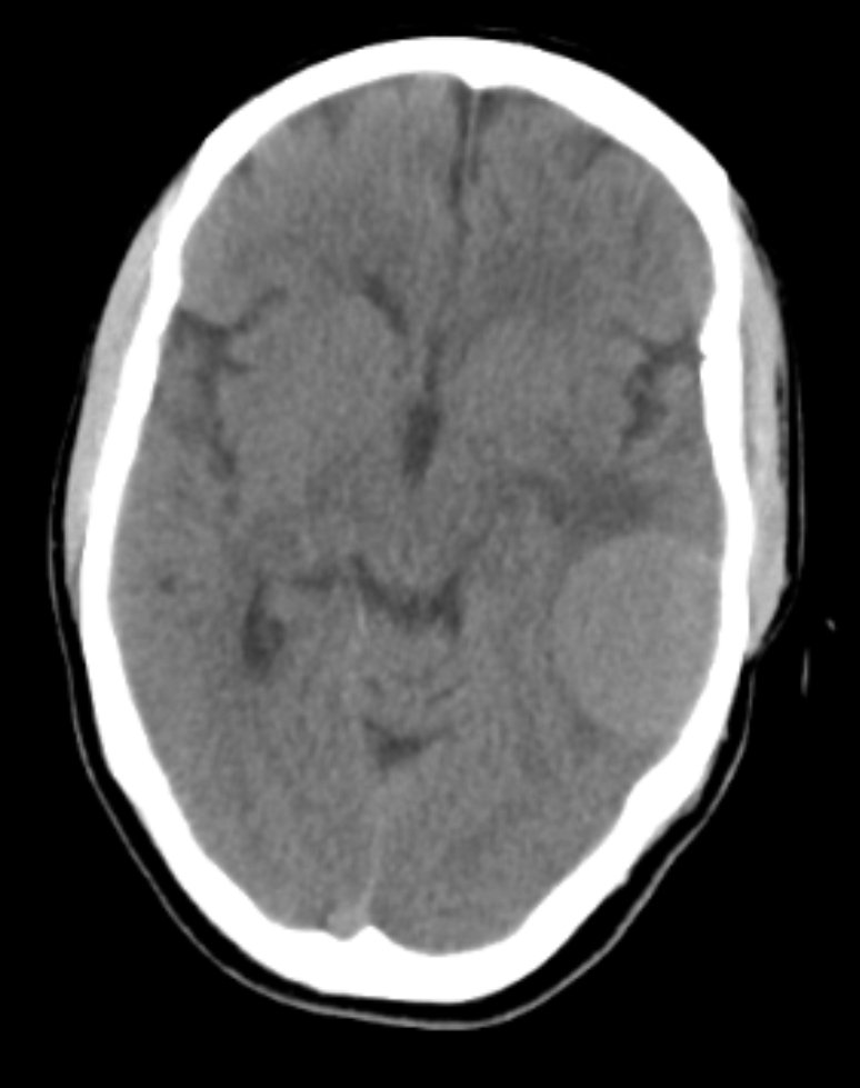 mo_ma1374's tweet photo. Good time, a 53 y/o female patient with headache, you see posterior temporal tumor(meningioma) which was successfully removed, Thanks to dear Professor Fakharian... https://t.co/aBE8clXgVH
