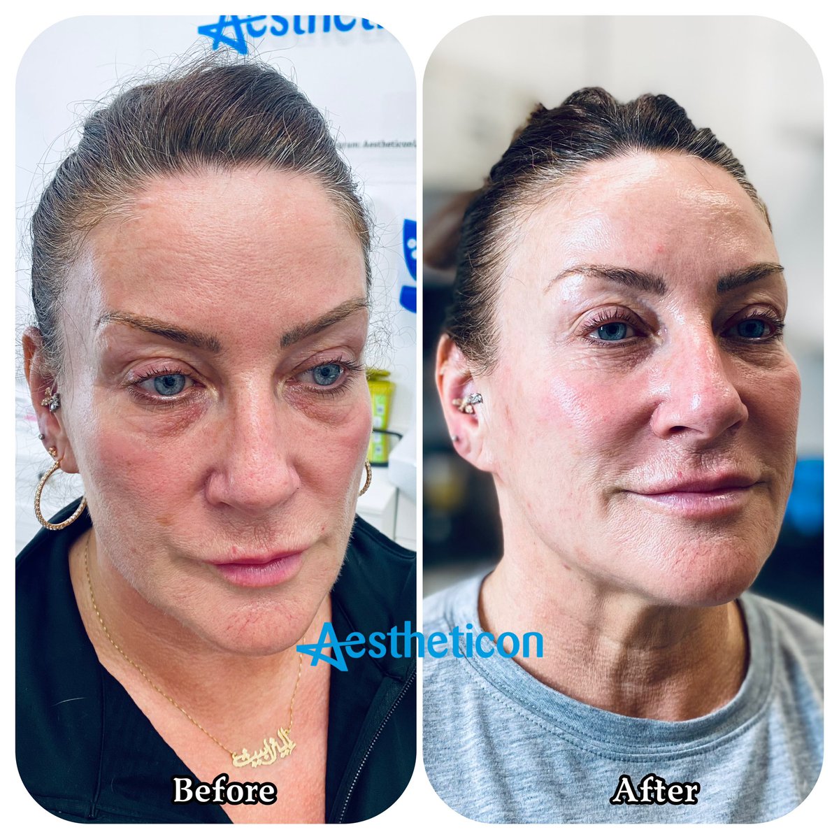 Definitely the kind of result we love to see 🤩💉💙 #FacialFillers #cheekfiller #chinfillers #dermalfillers #glasgowfillers #glasgowaesthetics #glasgowaestheticsnurse #glasgowaestheticsclinic