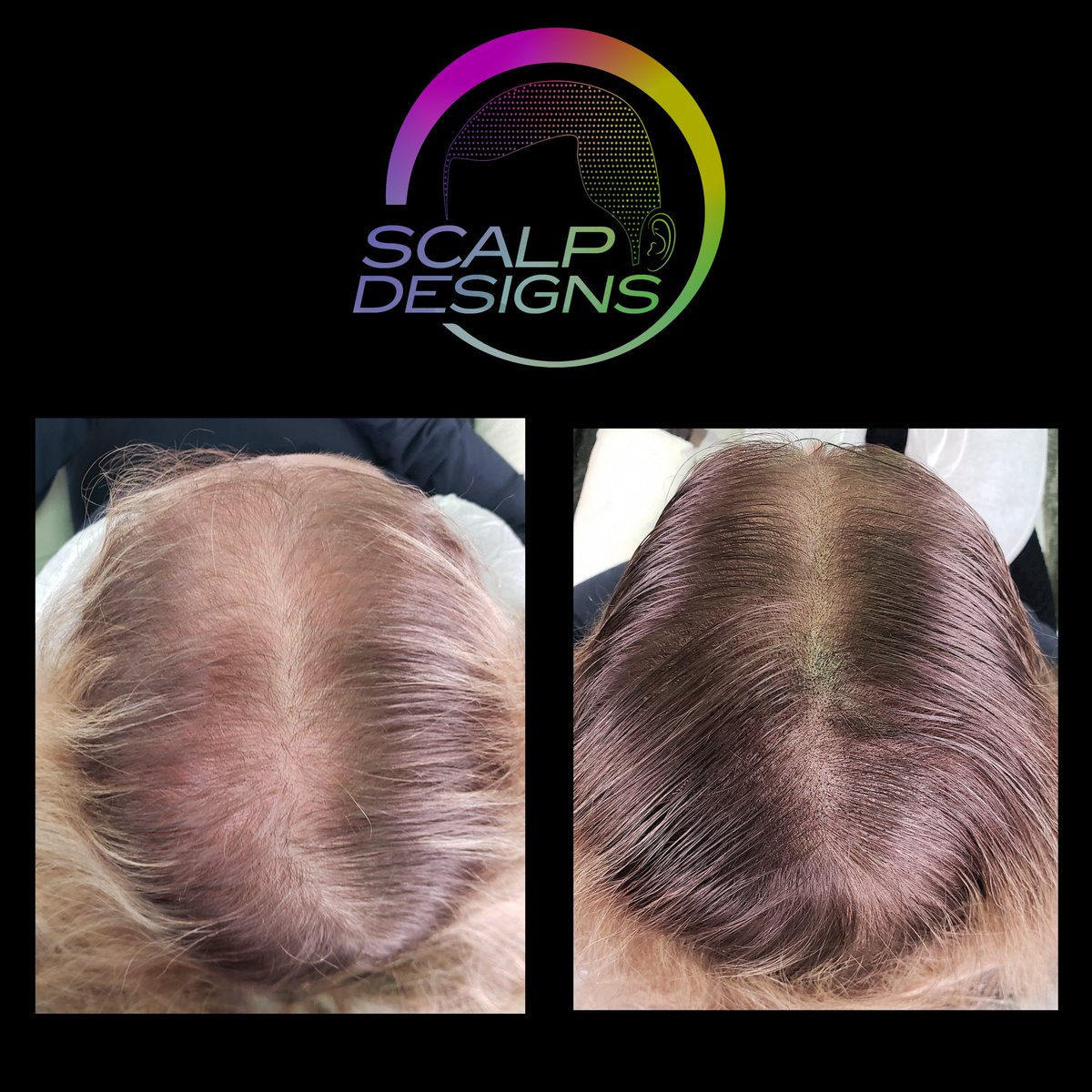 ScalpToti's tweet image. #1 Hair Loss Treatment for Women!!!!
HAIR TATTOO 🔫🔫🔫🔫 #hairtatoo
Scalp micropigmentation scalpdesigns.com #thinninghairsolution #scalpmicropigmentation #hairlosshelp #hairtattoo #alopecia #smp #boston 
#HairReplacement #hairlosssolution