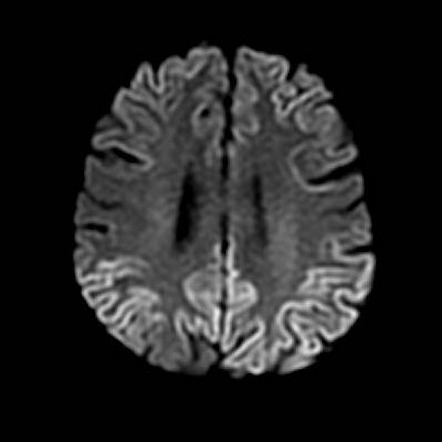Can you give a differential diagnosis for the "cortical ribbon sign."