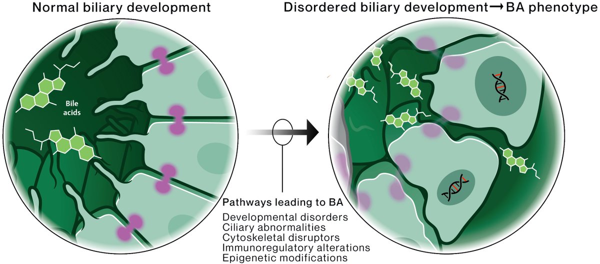 1st author review - written with my PI @saulkarpen - we discuss the genetic determinants that alter regulation of cholangiocyte development → inducing biliary atresia pathogenesis 🧬 A new framework for understanding BA etiology: thieme-connect.com/products/ejour…