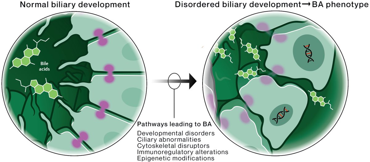 Dominick (@domhellen) on Twitter photo 1st author review - written with my PI <a href="/saulkarpen/">Saul Karpen</a> - we discuss the genetic determinants that alter regulation of cholangiocyte development → inducing biliary atresia pathogenesis 🧬
A new framework for understanding BA etiology:
thieme-connect.com/products/ejour… 1st author review - written with my PI <a href="/saulkarpen/">Saul Karpen</a> - we discuss the genetic determinants that alter regulation of cholangiocyte development → inducing biliary atresia pathogenesis 🧬
A new framework for understanding BA etiology:
thieme-connect.com/products/ejour…