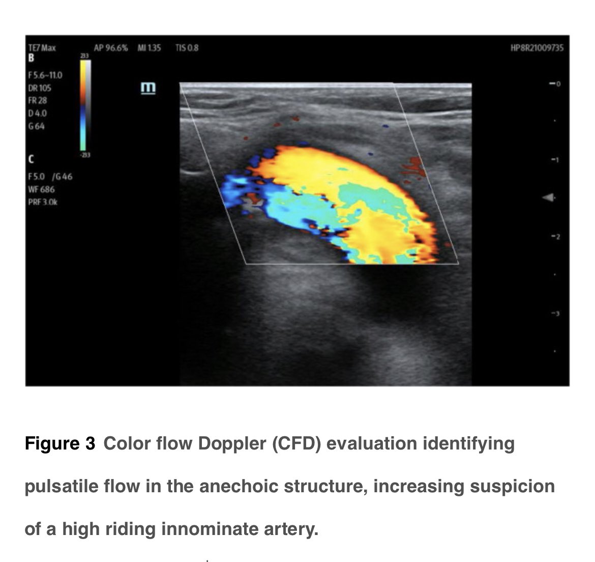 #POCUS Doing PDT #tracheostomy in ICU … then #airwayultrasound is a valuable tool to avoid catastrophic ⚠️ 🩸events How and Why? 👉 jcvaonline.com/article/S1053-… @JCVAonline @pandompatam @nathanhwaldron @townsley_matt Watch 🎥 also! @MayoClinicCCM @drprash89 @pkguru10 @ASRA_Society