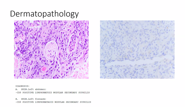 Great cases from NYC ID fellows at IDSNY intercity Rounds tonight! Congrats to our fellows Lee and Alex on presenting interesting cases of Loa Loa and secondary syphillis.