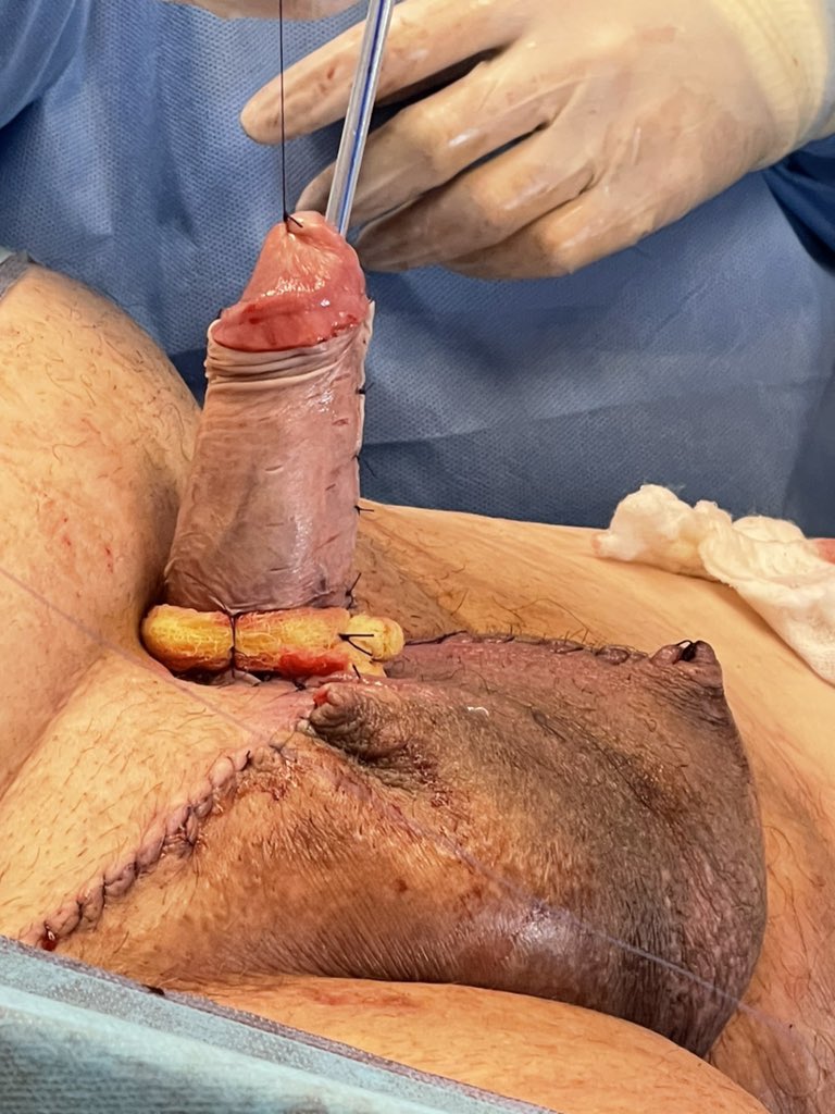 65-year-old patient with acquired buried penis resulting from lichen sclerosus and obesity.
Escutcheonectomy + peri-penile skin excision + split thickness skin graft was performed.

<a href="/UroHIBA/">UroHIBA</a> 
<a href="/fedetirapegui/">fedetirapegui</a> 
#CarlosGiudice