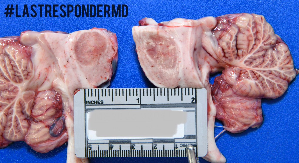 Fun surprise finding during an autopsy (hence the sagittal section). Any resident/student want to hazard a guess? What kind of history would you expect for this finding. Bonus: This person was NOT hospitalized prior to death. #4n6 #neurology #autopsy