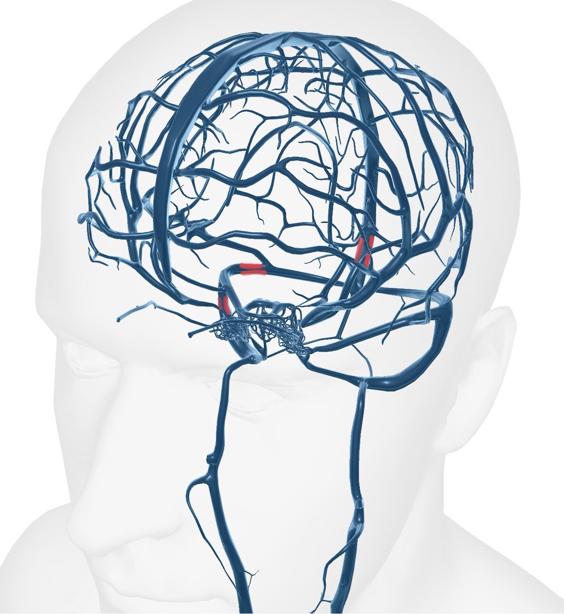 XRPL__A's tweet photo. The most common sites of venous stenosis in Idiopathic intracranial hypertension (IIH).- the transverse- sigmoid junction, posterior sigmoid and distal superior sagittal sinus https://t.co/7kHurbC82B