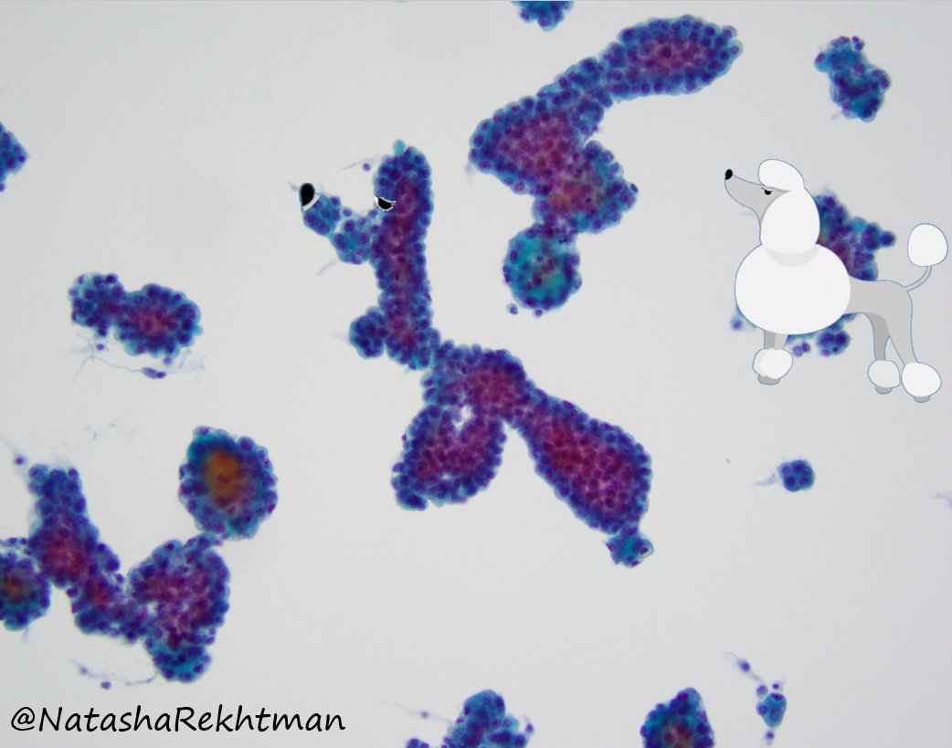 natasharekhtman's tweet photo. Hi #pathology friends!
Pleural effusion. Do you see what I see? 🐩
When mesothelial cells form complex arborizing groups like this - it is a good clue to mesothelioma. 
So .. new diagnostic term: the “poodle sign”? 
#PathArt https://t.co/kFV0b3WbmT