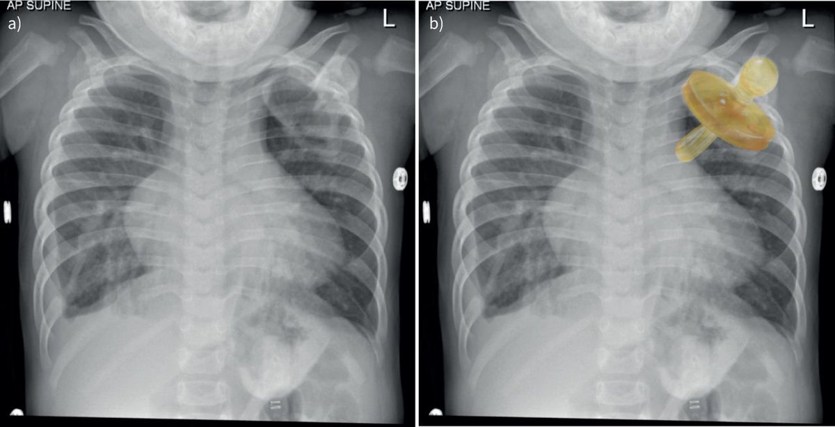 Radiography is a difficult job and not every imaging study is perfectly performed, especially in paediatric cases. This case series highlights the importance of correct interpretation of radiological studies and recognising that all is not what it seems. bit.ly/3r4qBSU