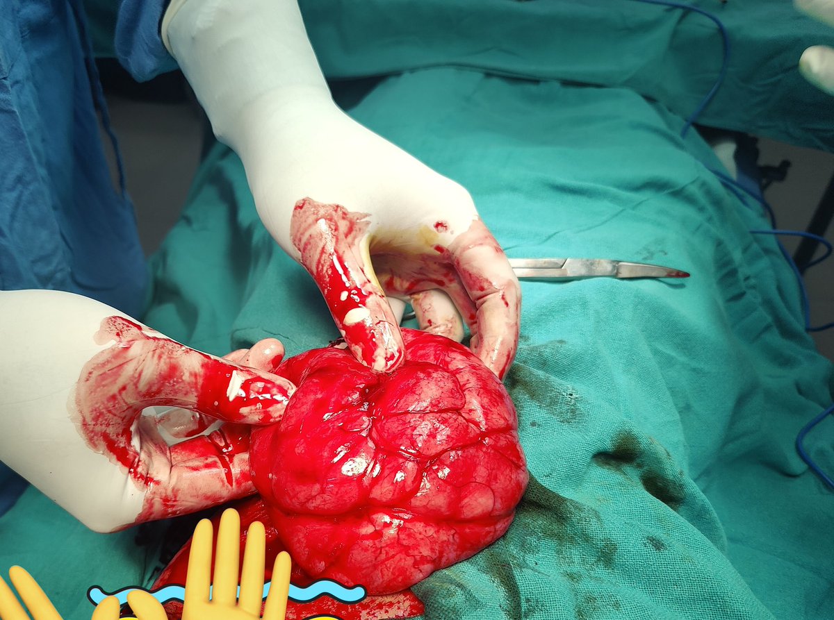 Nindrajeet (@sleep_conquerer) on Twitter photo Believe me or not ...This is a fibroadenoma Breast...never seen this big before!!
#MedTwitter <a href="/docrohan/">Rohan Khandelwal</a> Believe me or not ...This is a fibroadenoma Breast...never seen this big before!!
#MedTwitter <a href="/docrohan/">Rohan Khandelwal</a>